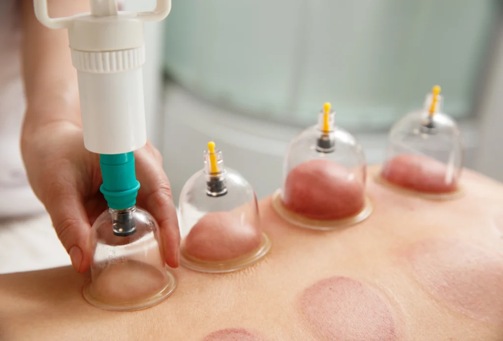 Steve Bailey Acupuncture Academy - Courses - Professional Cupping Therapy Certificate